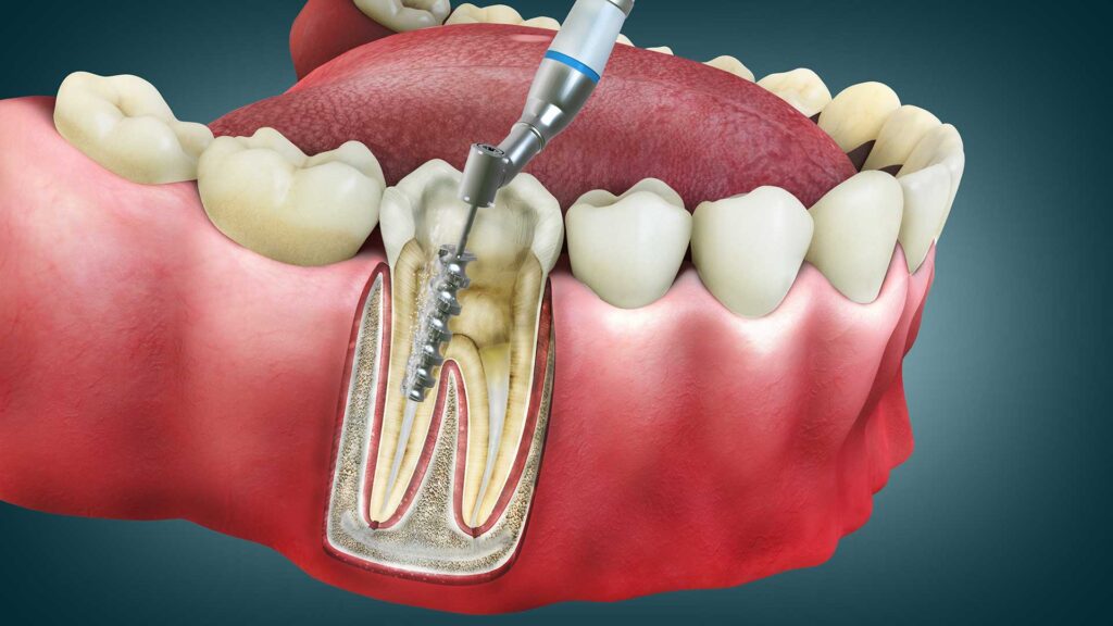 Çerkezköy endodonti ve kanal tedavisi